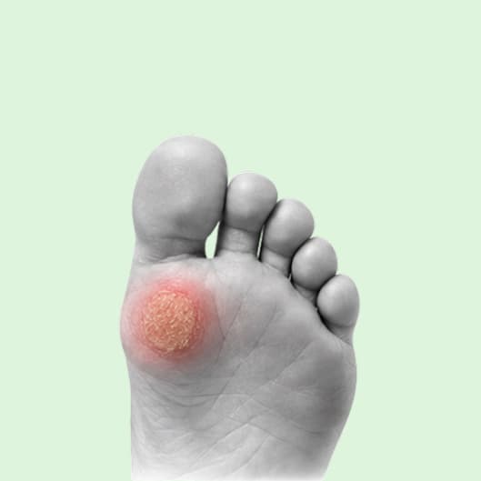Sole of a foot with a circular highlighted area beneath the toes.