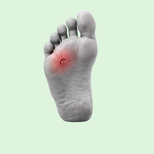 Sole of a foot with a highlighted area beneath the forefoot.