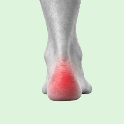 Rear view of a foot with the heel highlighted.